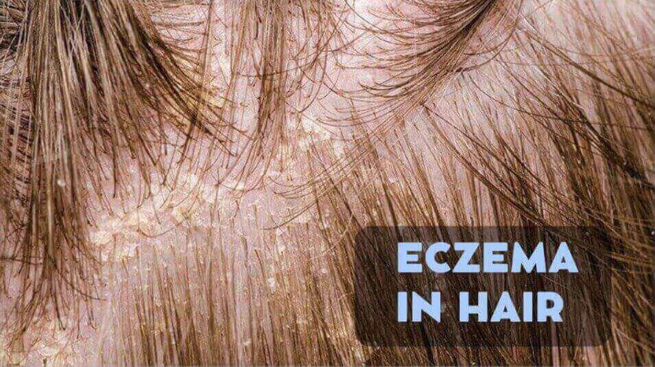 eczema related hair loss