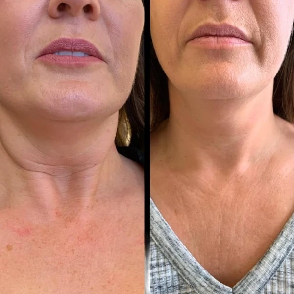 Profhilo treatment in dubai