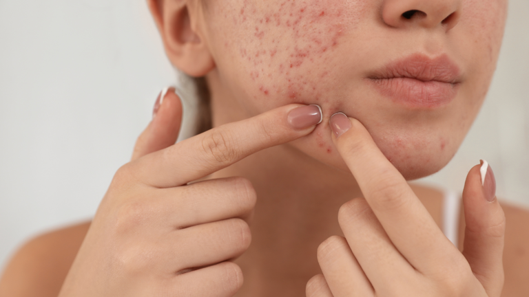 pimples treatment in Islamabad