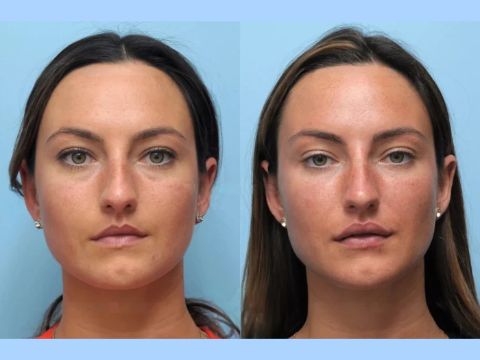 Thread Lift in Dubai with Natural-Looking Results