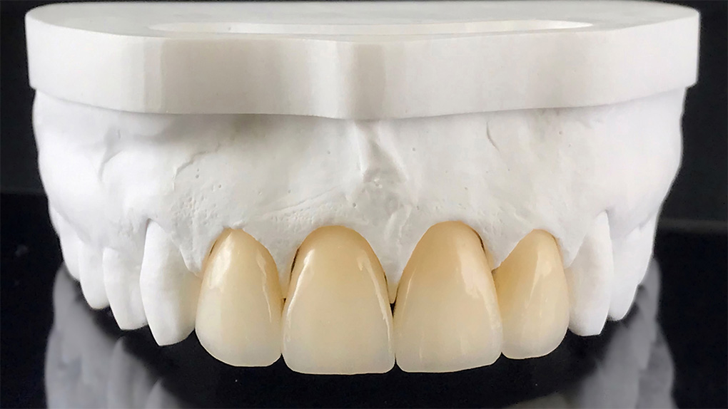 Zirconia Crown Dubai