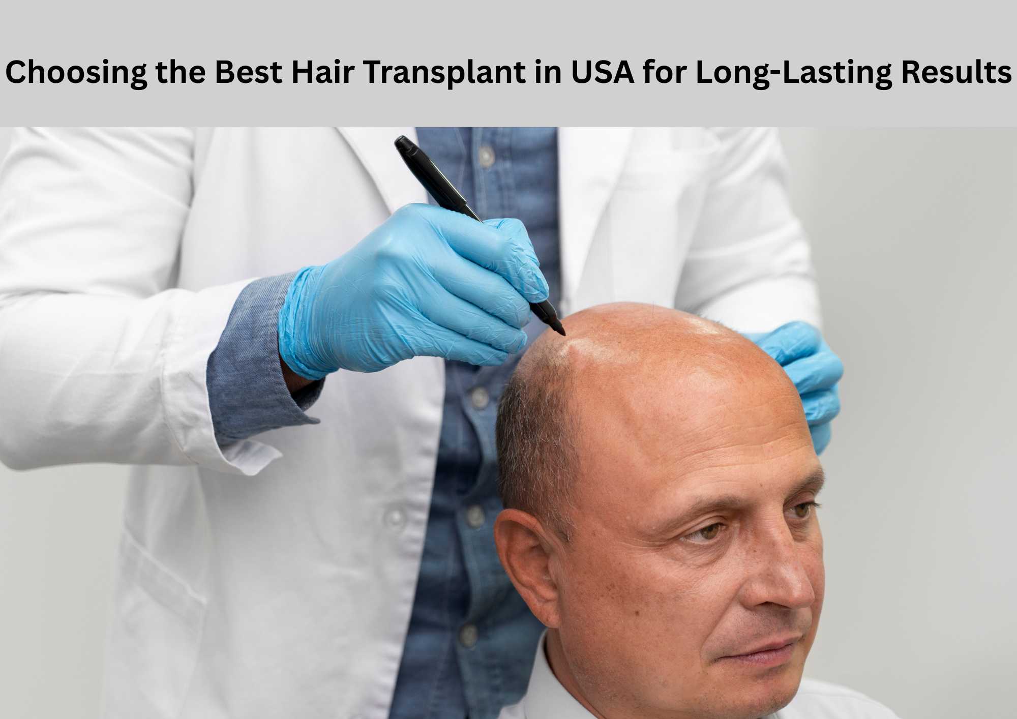 Choosing the Best Hair Transplant in USA for Long-Lasting Results