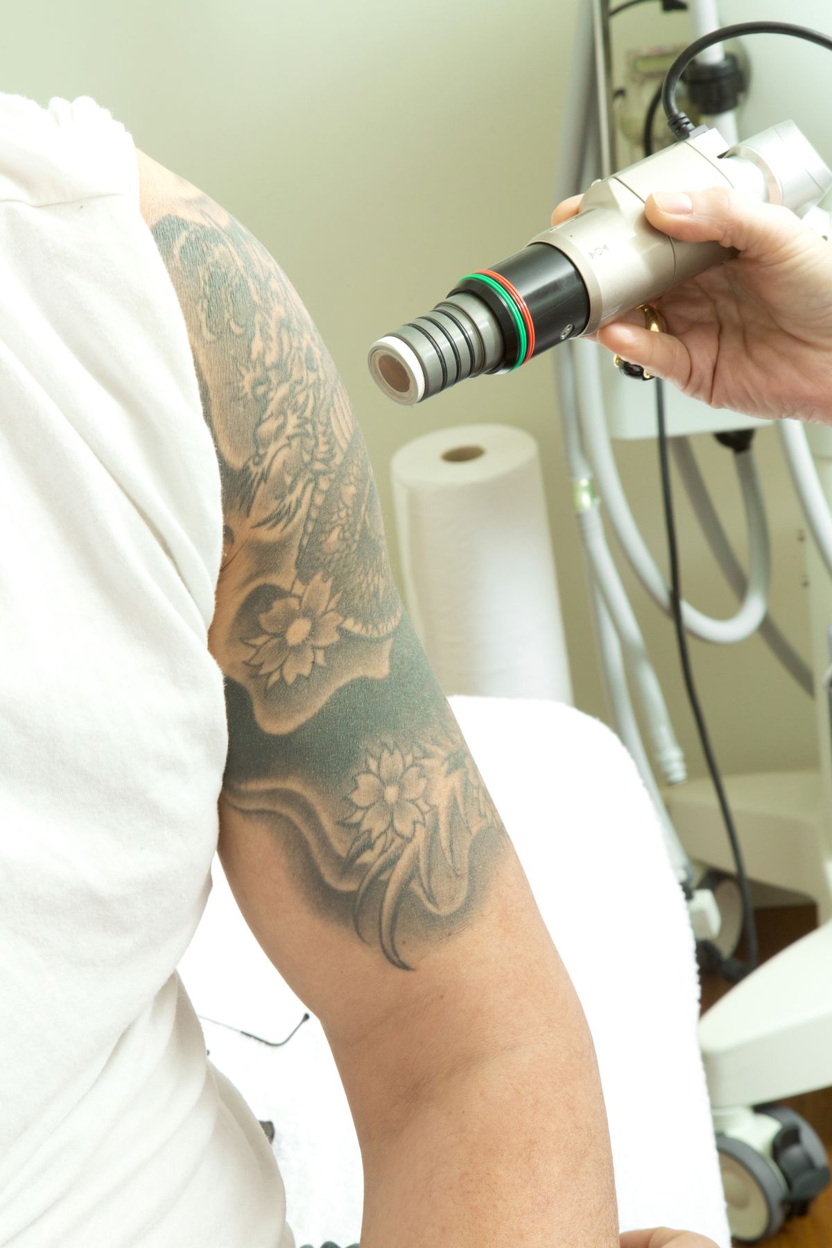 Laser Tattoo Removal