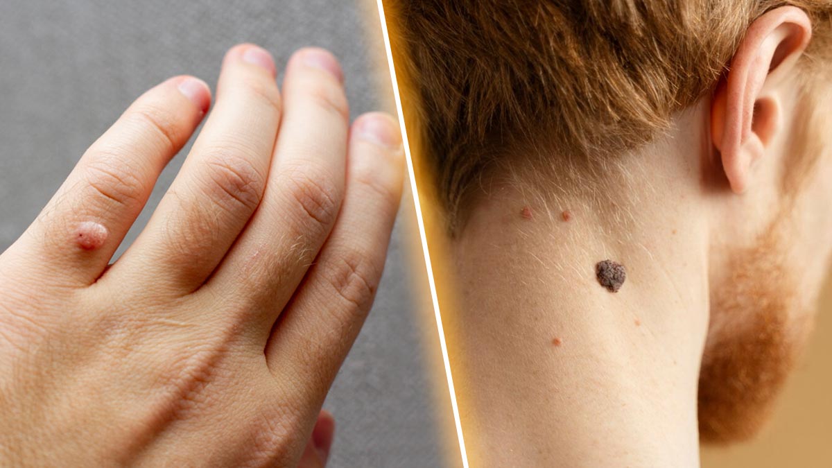 Are Skin Tags Contagious