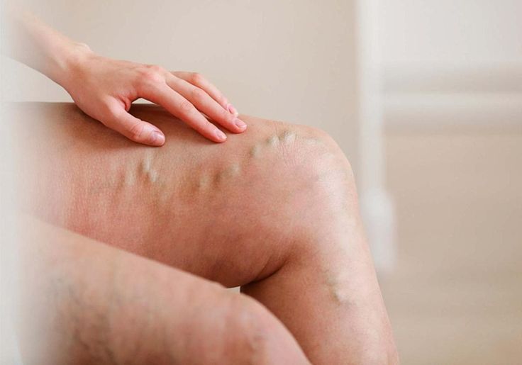 Varicose Treatment in Riyadh