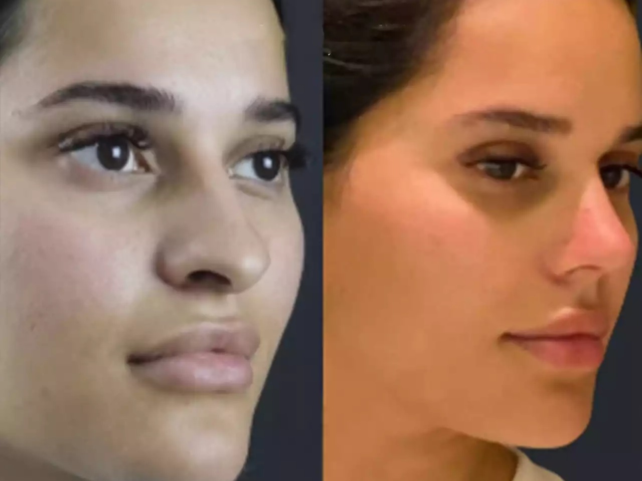 Rhinoplasty Surgeons in Dubai