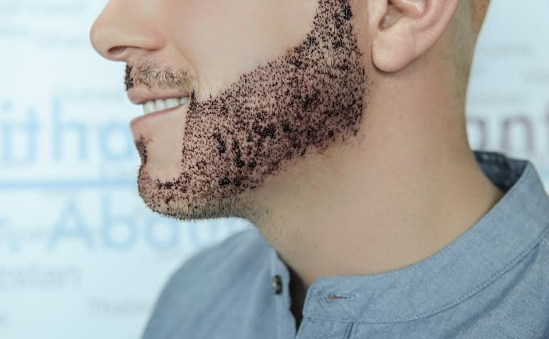 beard hair transplant in Islamabad