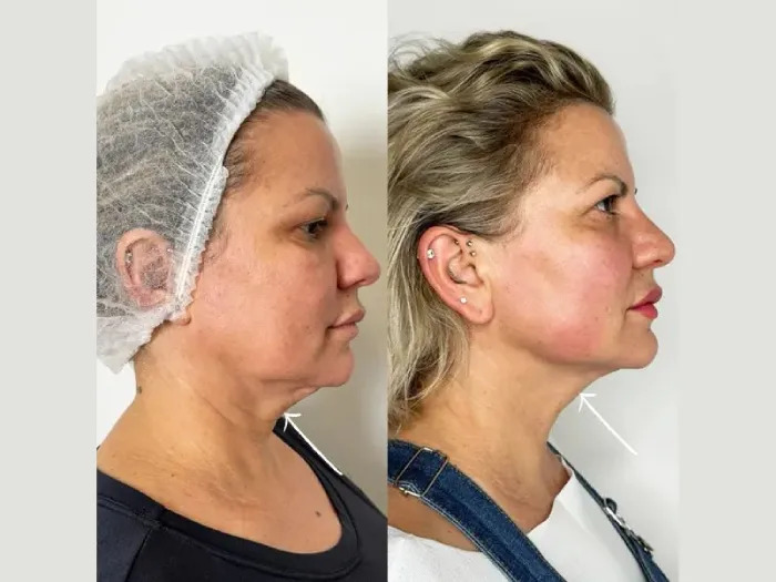 Endolift Treatment in Dubai vs Traditional Facelift: Expert Insights